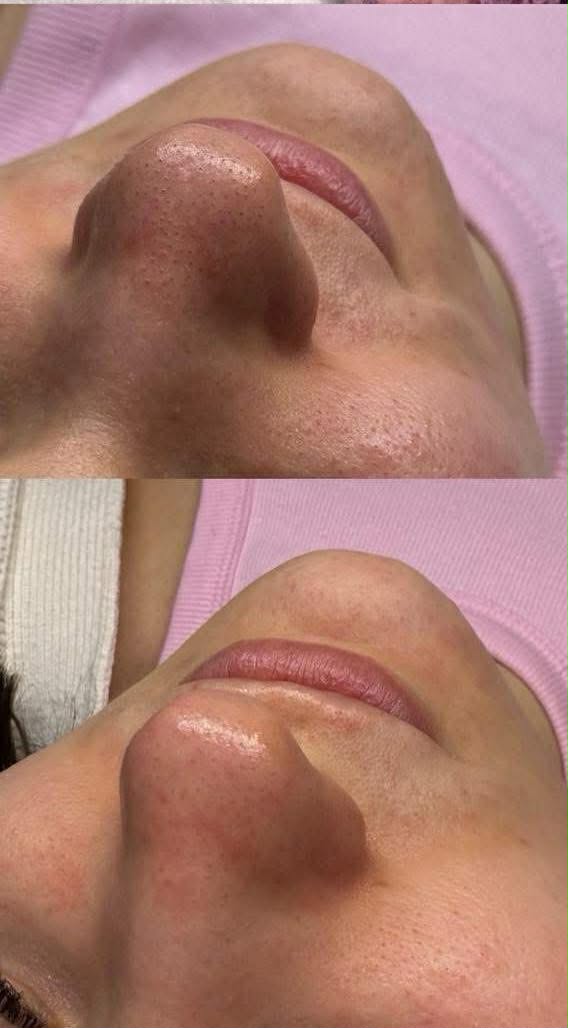 Peeling węglowy – efekty